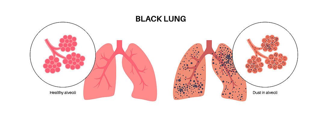 Coal workers disease, illustration