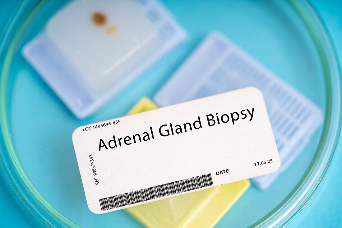 Adrenal gland biopsy