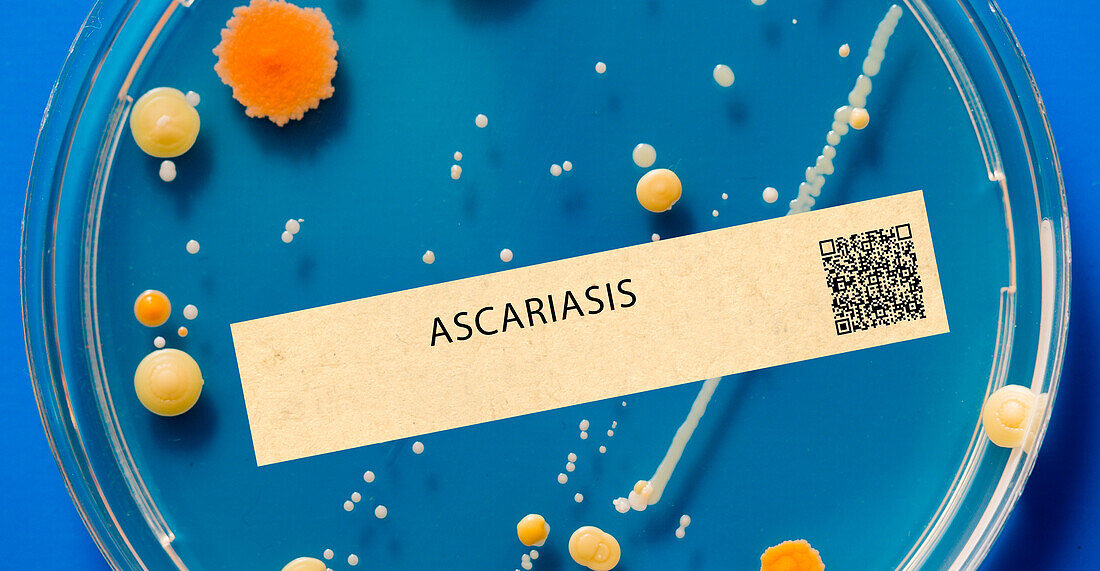 Ascariasis intestinal parasitic infection