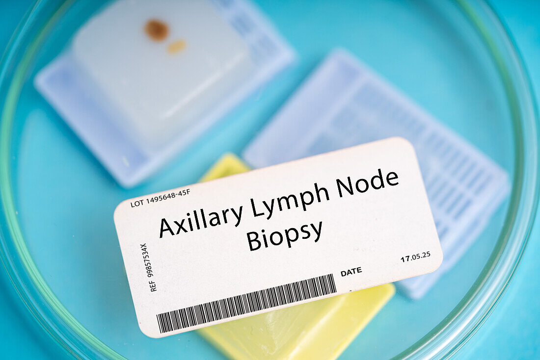 Axillary lymph node biopsy