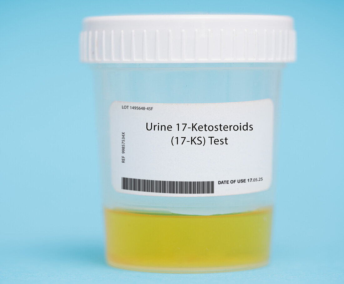 Urine 17-ketosteroids