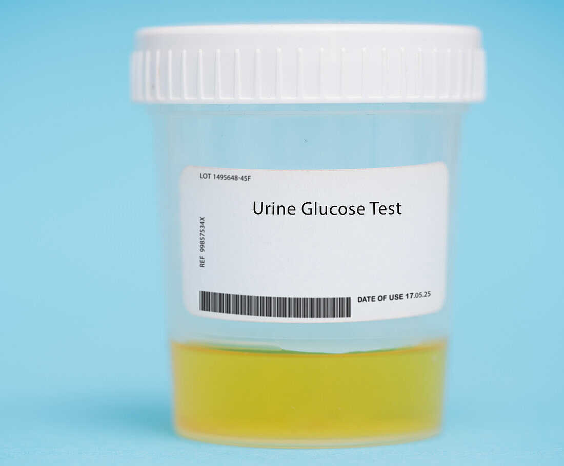 Urine glucose test