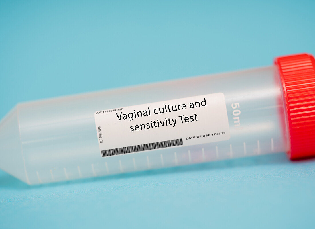 Vaginal culture and sensitivity test