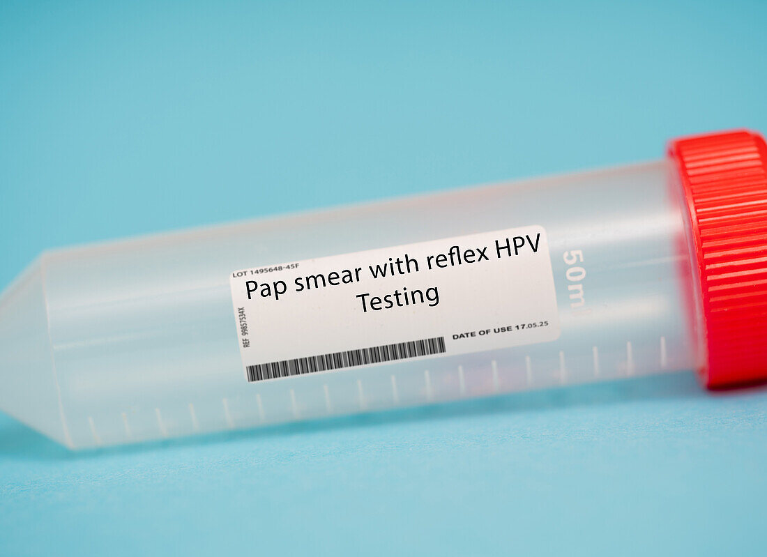 Pap smear with reflex HPV testing