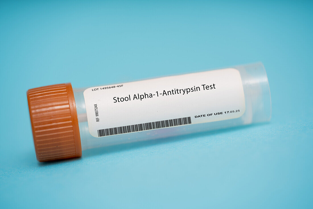 Stool alpha-1-antitrypsin test