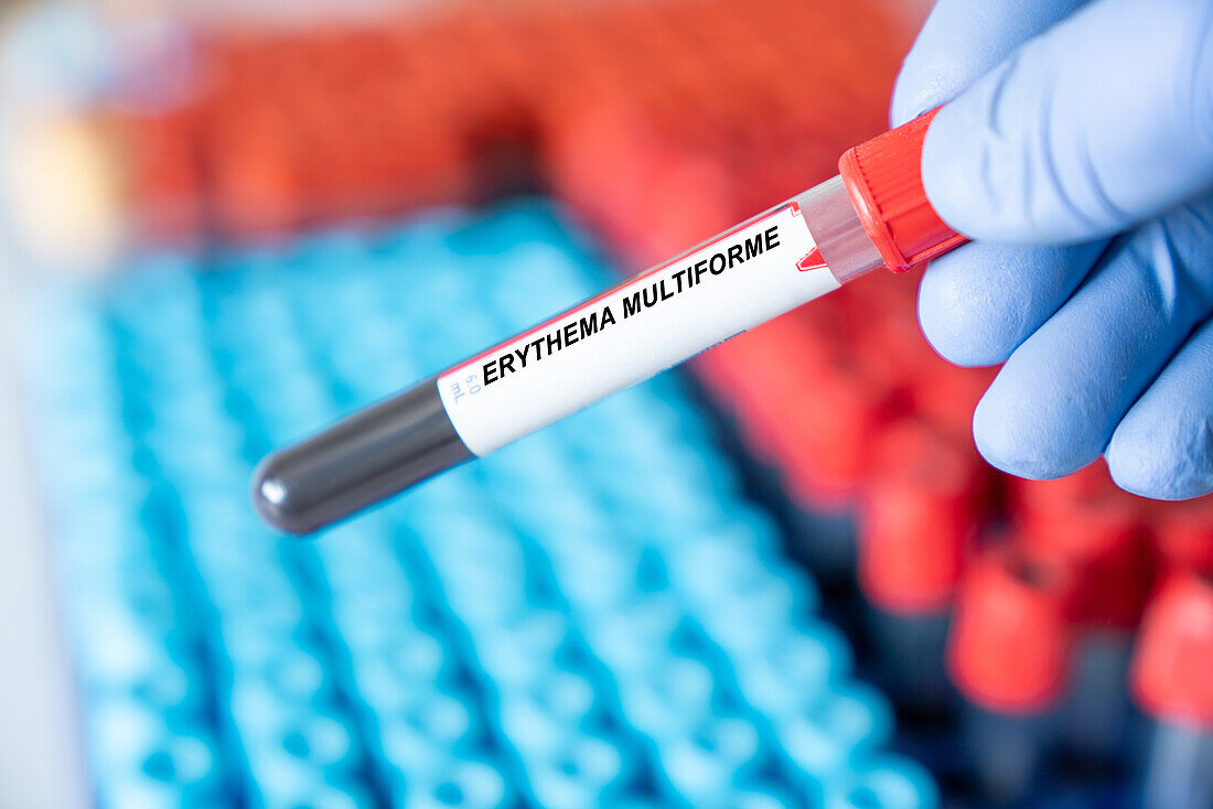 Erythema multiforme blood test