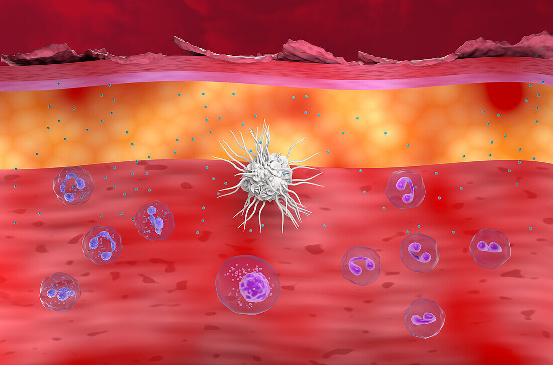 Atopic dermatitis, illustration