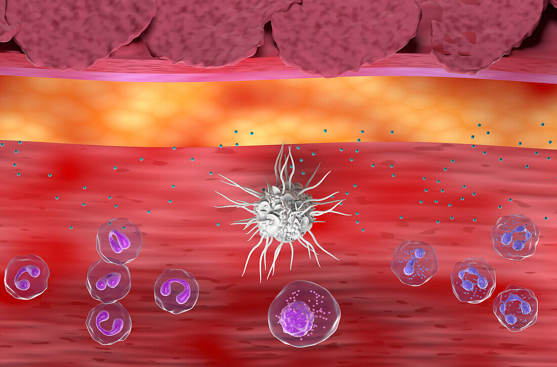 Atopic dermatitis, illustration