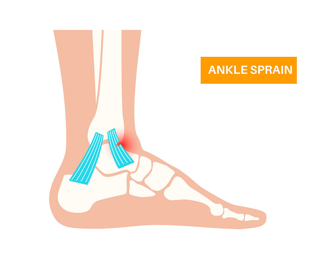Ankle sprain injury, illustration