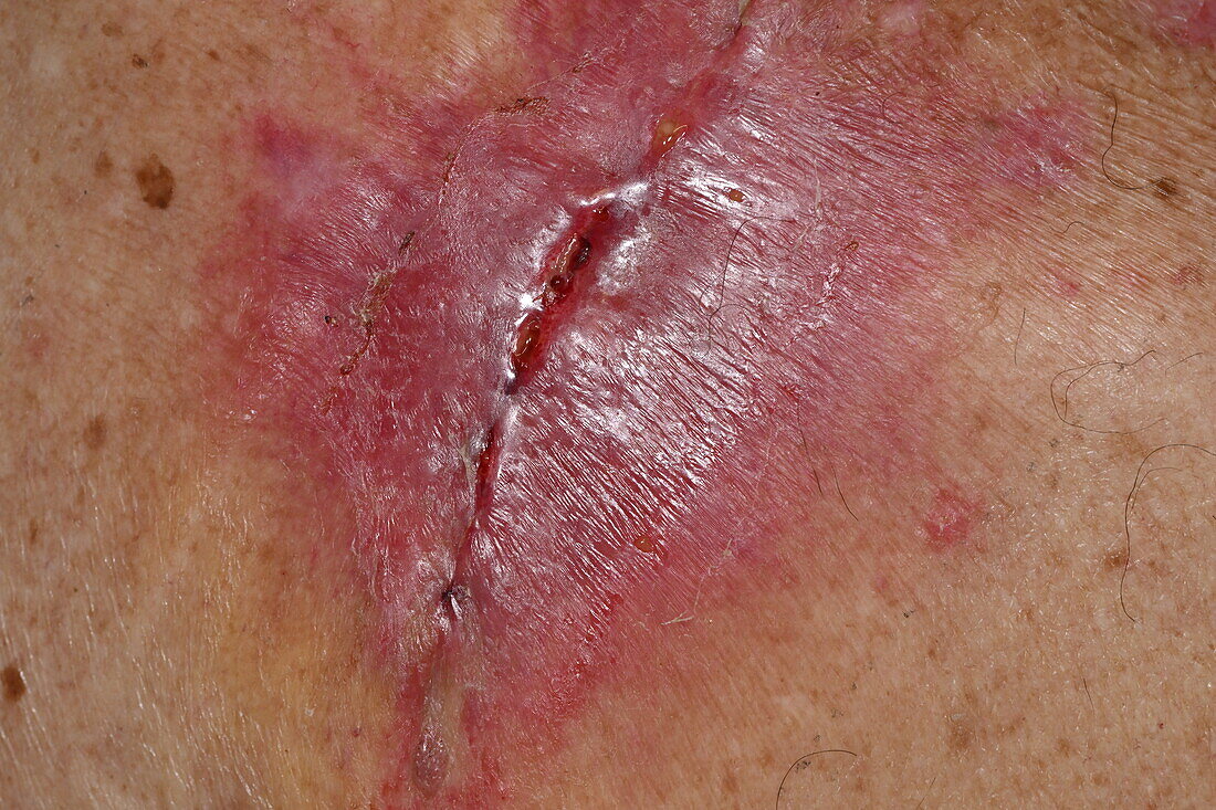 Infected wound following surgery on a woman's shoulder