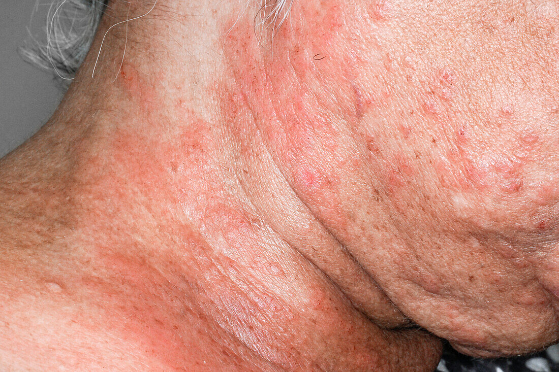 Atopic eczema on a woman's neck