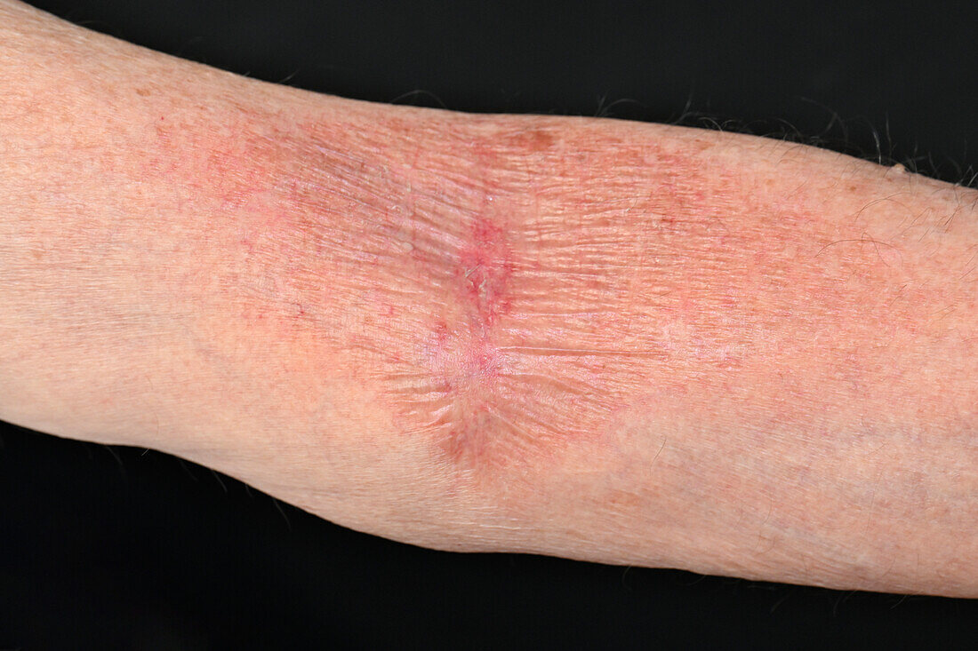 Eczema on a man's inner elbow