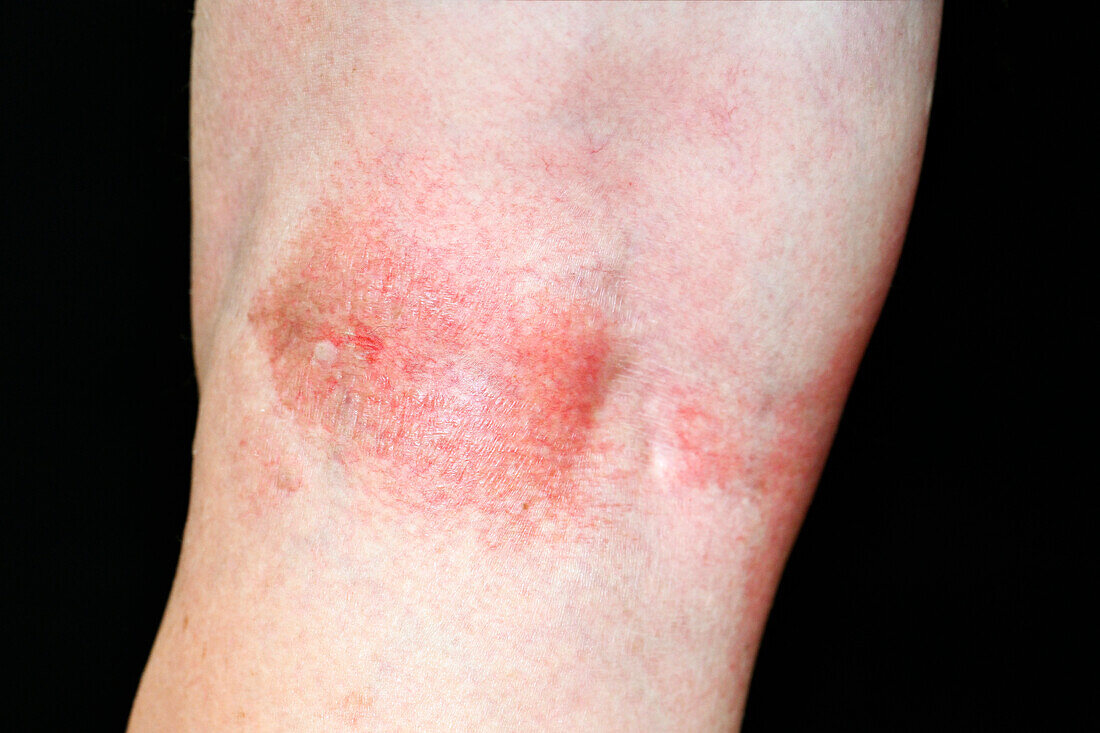 Eczema on the back of a man's knee