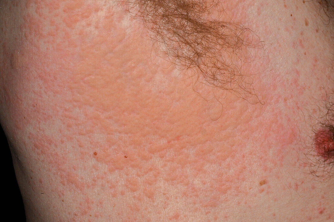 Hives on a man's trunk