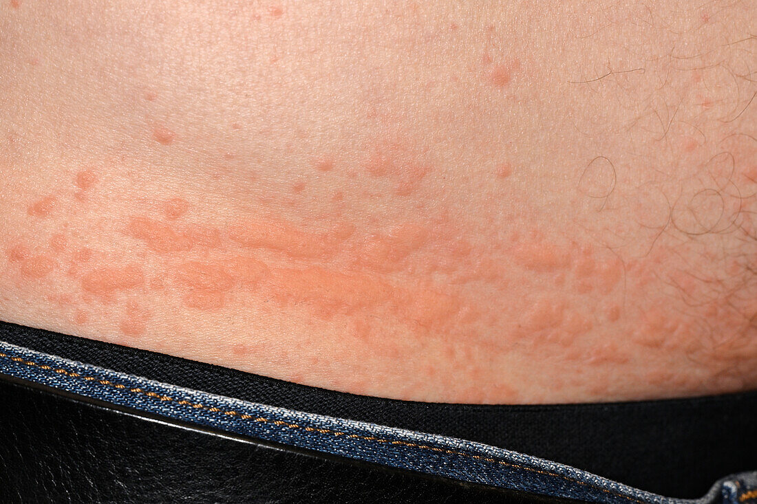 Hives on a man's abdomen