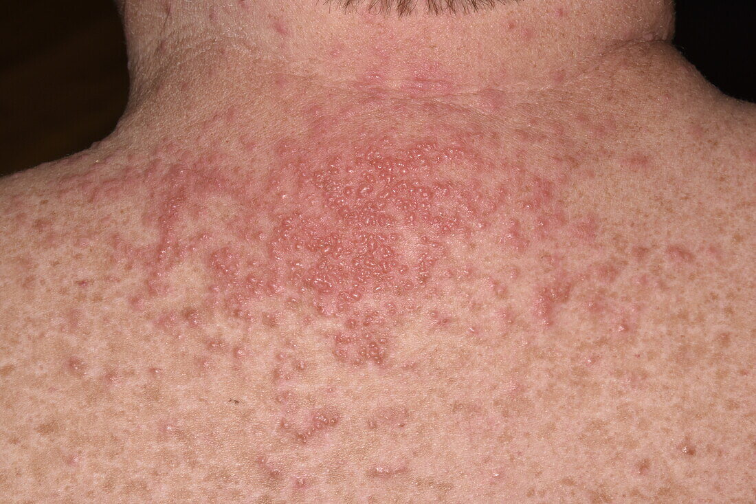 Eczematous rash on the back of a man's neck