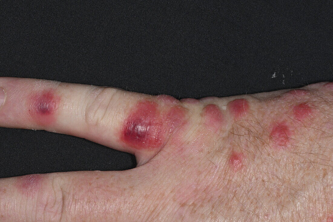 Reaction to insect bites on a woman's hand
