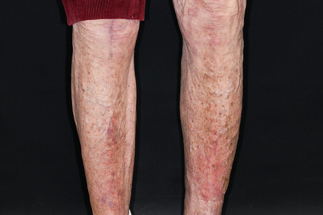 Deep vein thrombosis in a man's legs