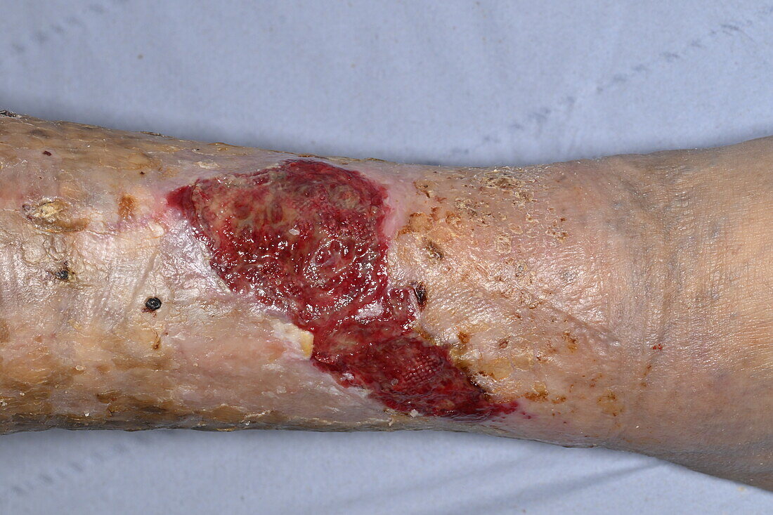 Leg ulceration in a 77 year old male patient