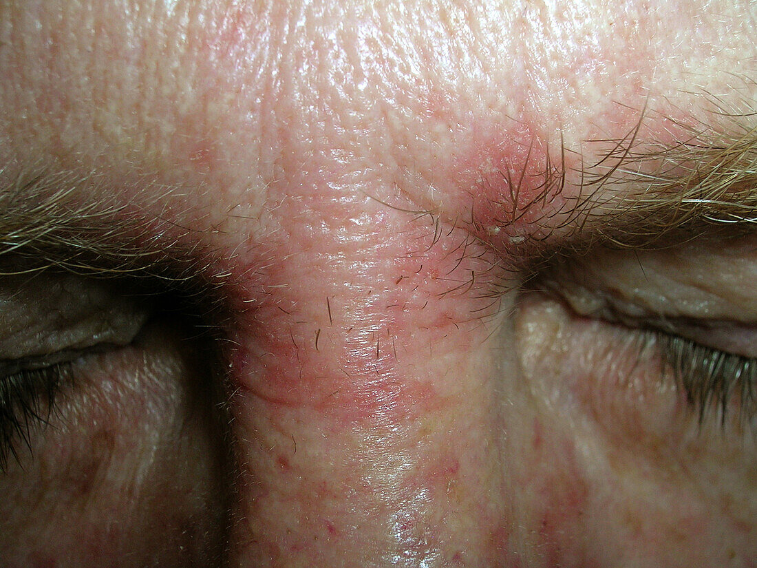 Seborrheic dermatitis