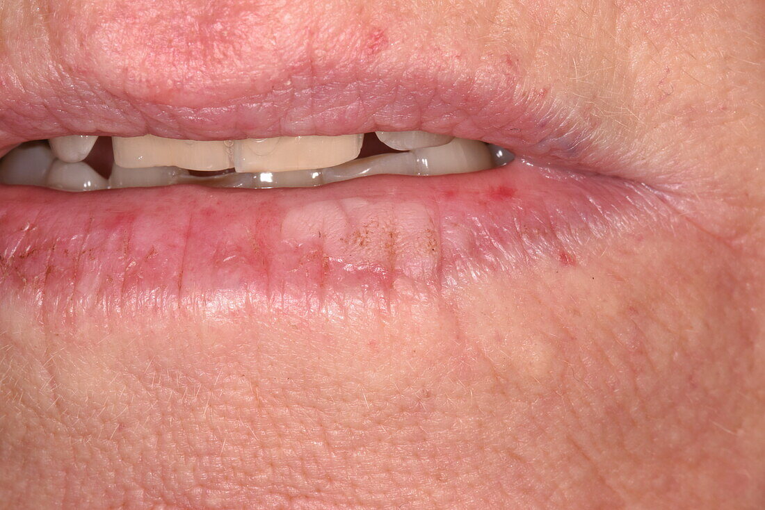 Solar keratosis on a woman's lip