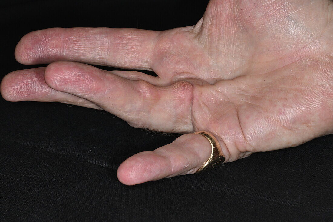 Dupuytren's contracture in a man's hand
