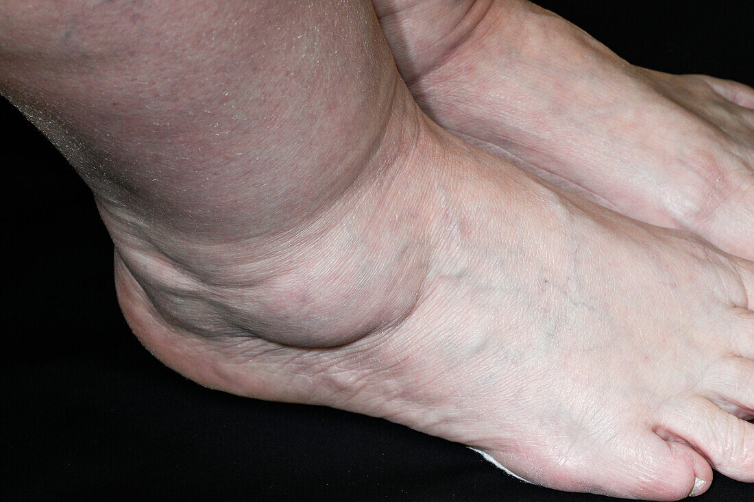 Ganglion cyst on a woman's ankle
