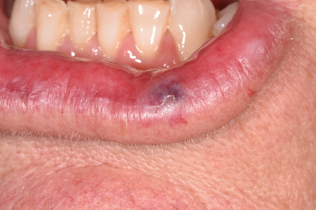 Cavernous haemangioma on a woman's lip