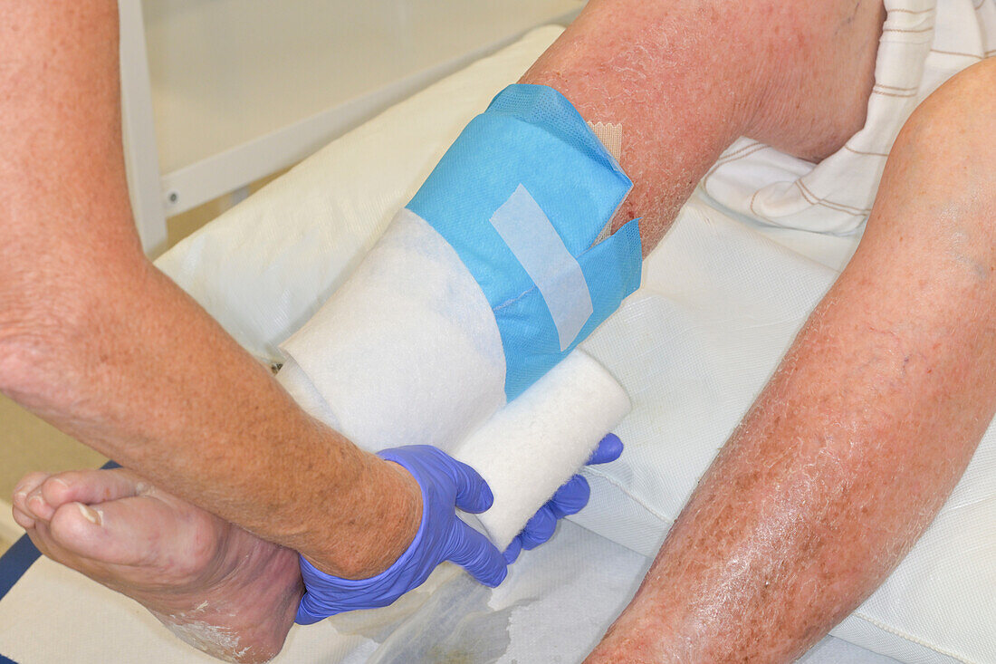 Leg dressing in patient with varicose eczema