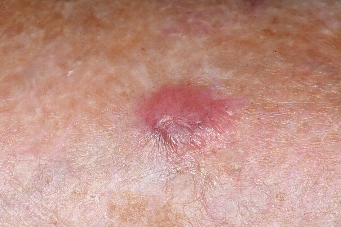 Amelanotic melanoma on a woman's shin
