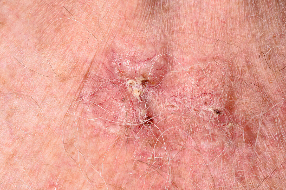 Basal cell carcinoma on a man's chest
