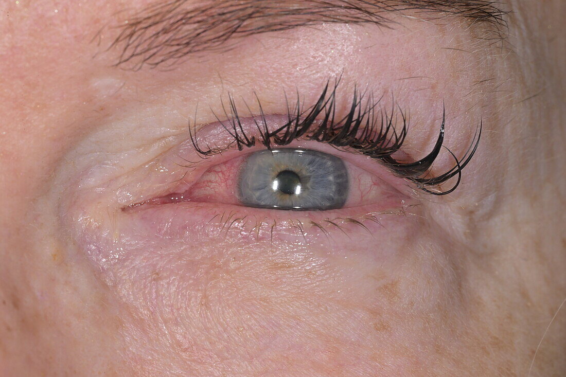 Marginal keratitis in a woman's eye