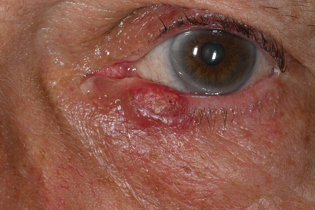 Meibomian cyst on a woman's eyelid