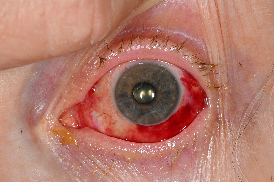 Eye post vitrectomy in a female patient