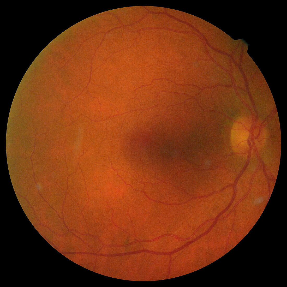 Healthy eye, funduscopy scan