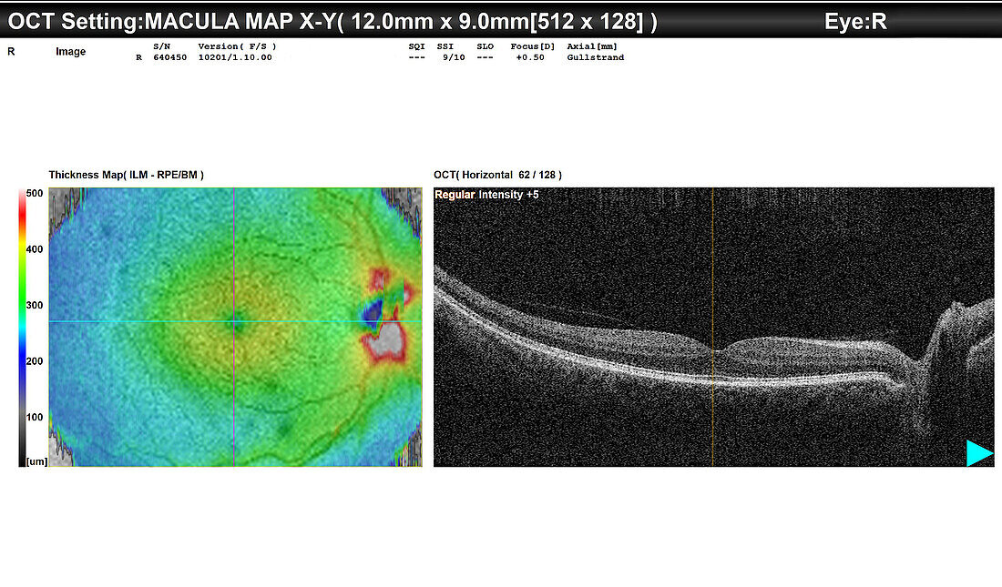 Healthy eye, OCT scan