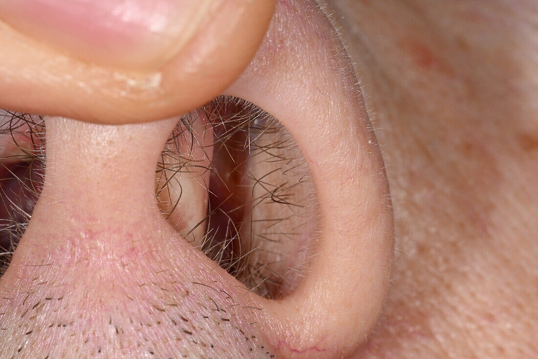 Poor nasal airway in male patient