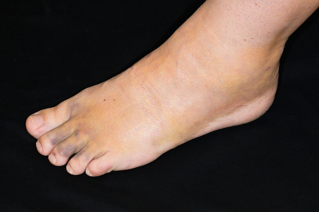 Swelling from sprained ankle in female patient