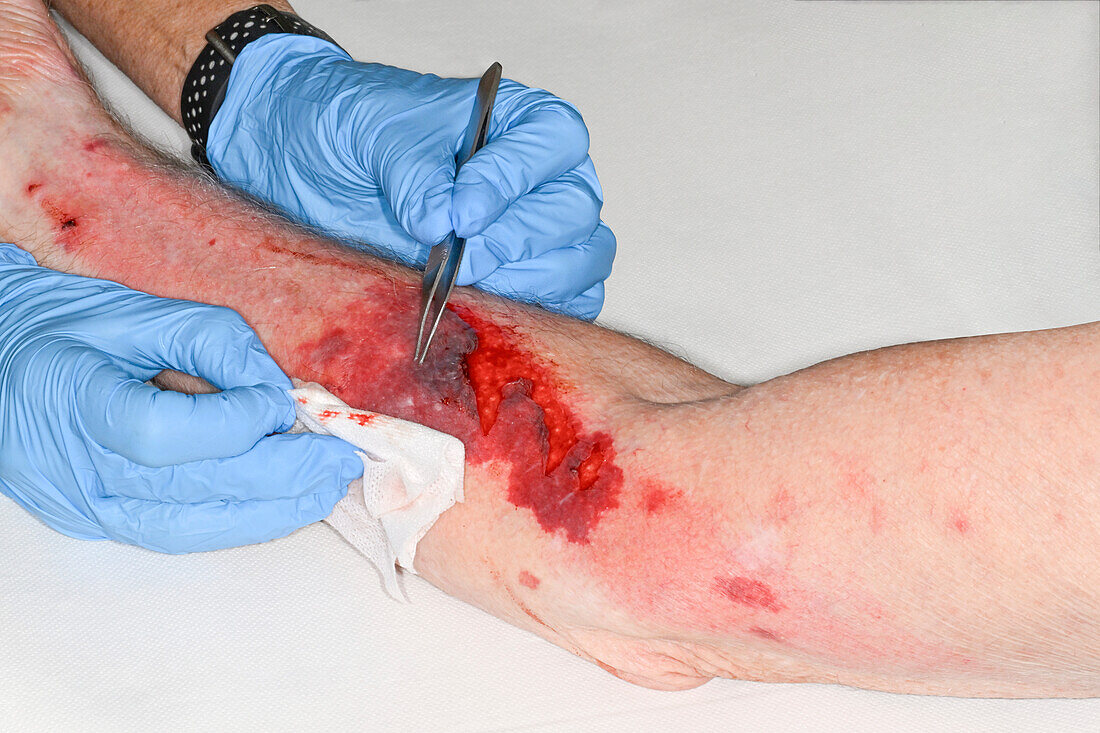 Flap laceration on a man's forearm