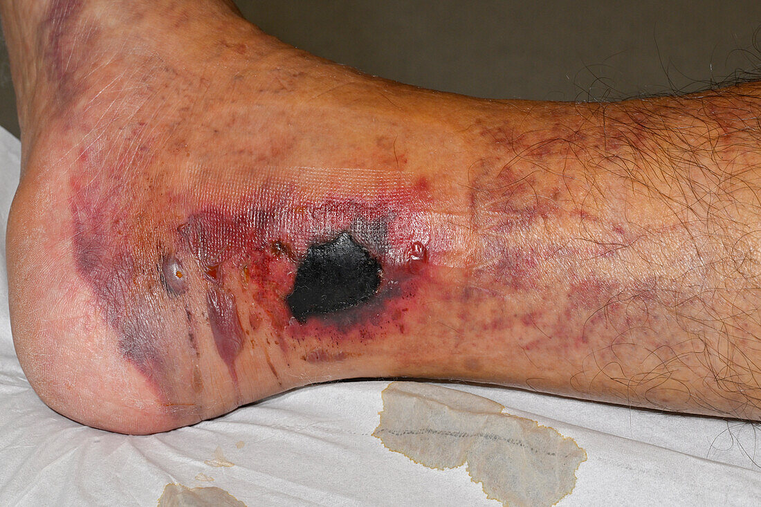 Large haematoma on a man's ankle