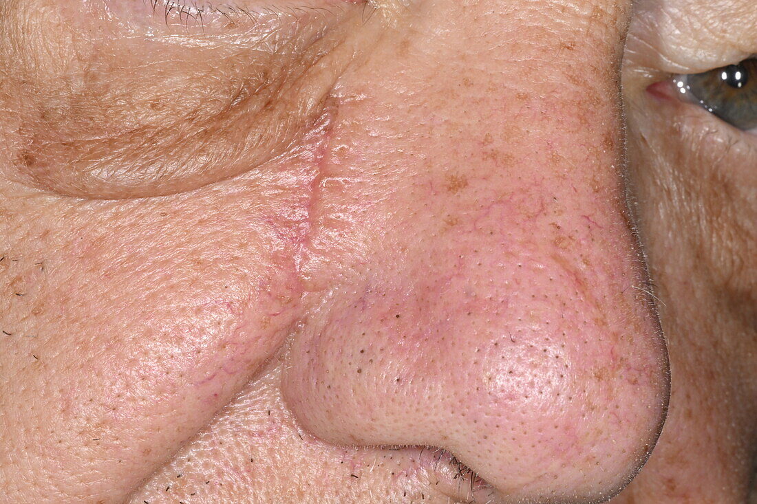 Scar after basal cell carcinoma excision