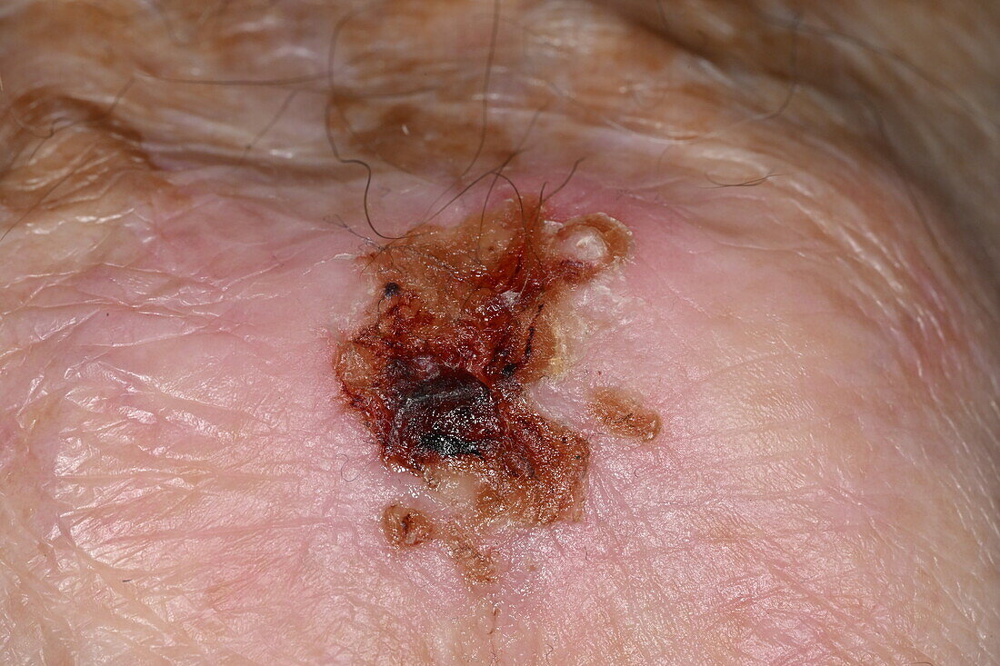 Basal cell carcinoma on a man's hand