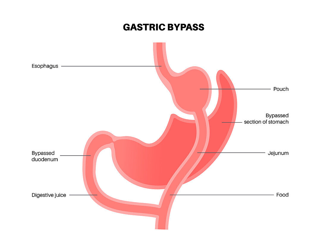 Gastric bypass surgery, illustration