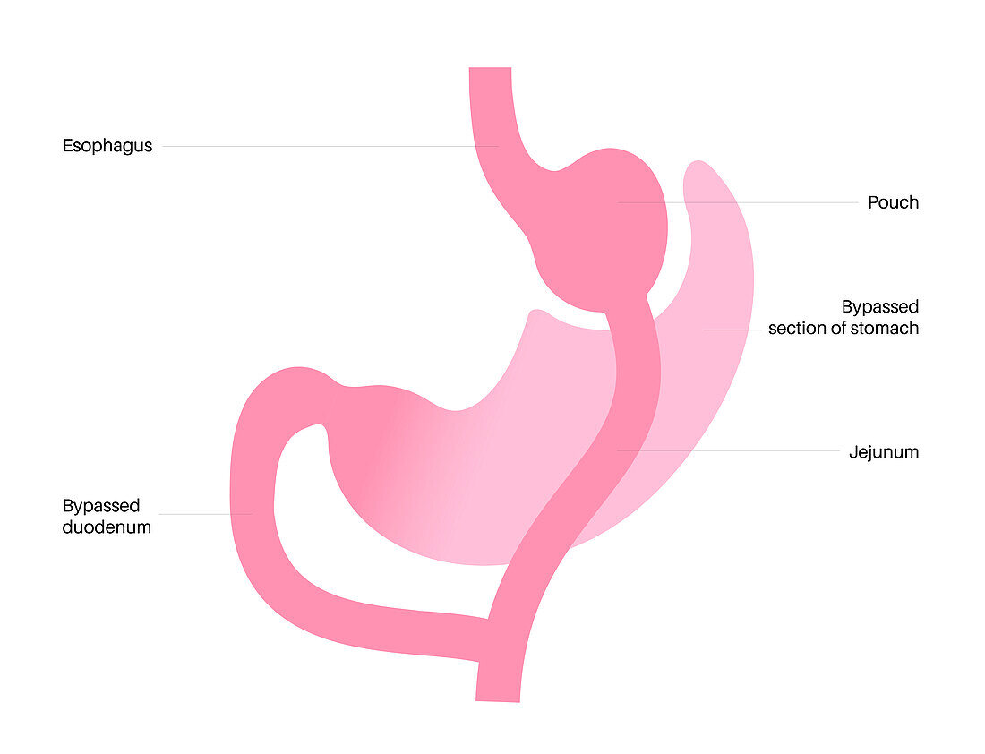 Gastric bypass surgery, illustration