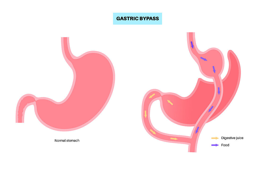 Gastric bypass surgery, illustration