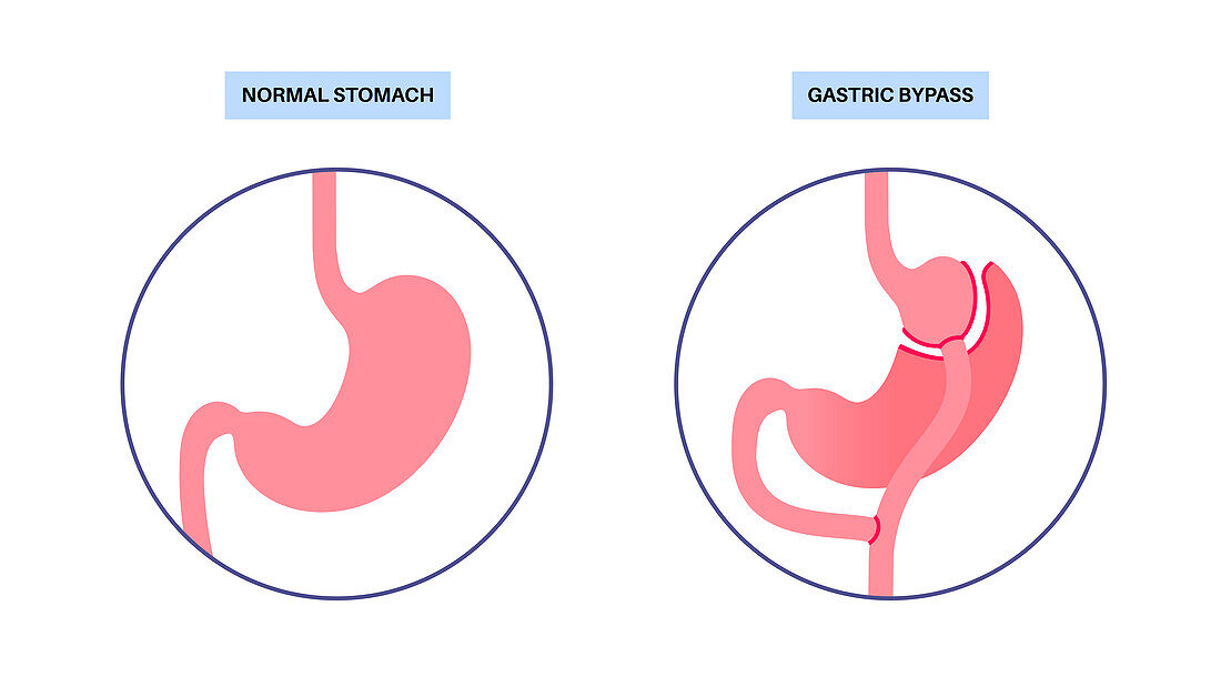 Gastric bypass surgery, illustration