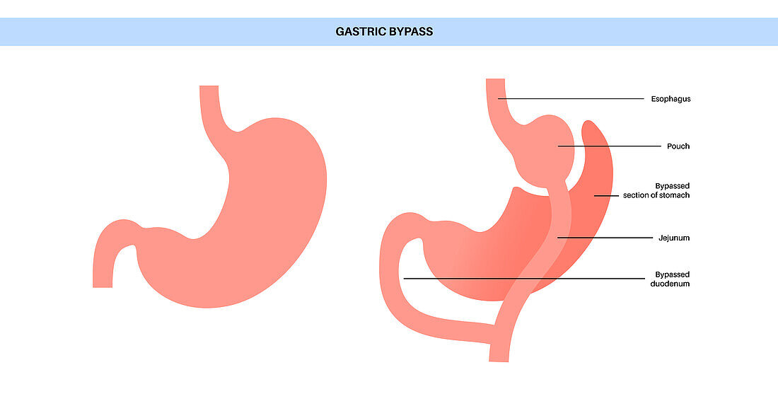 Gastric bypass surgery, illustration