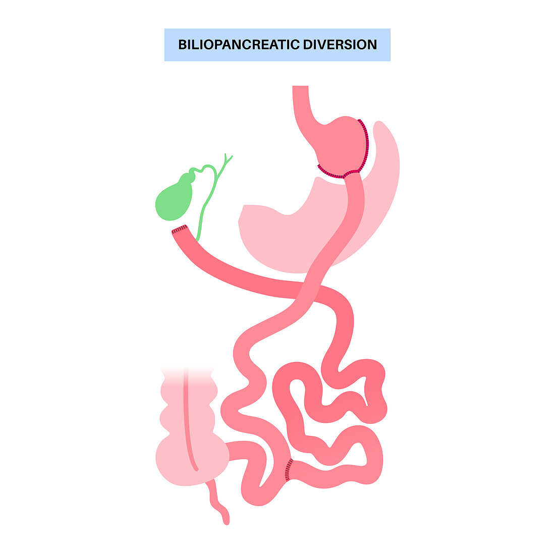 Biliopancreatic diversion procedure, illustration