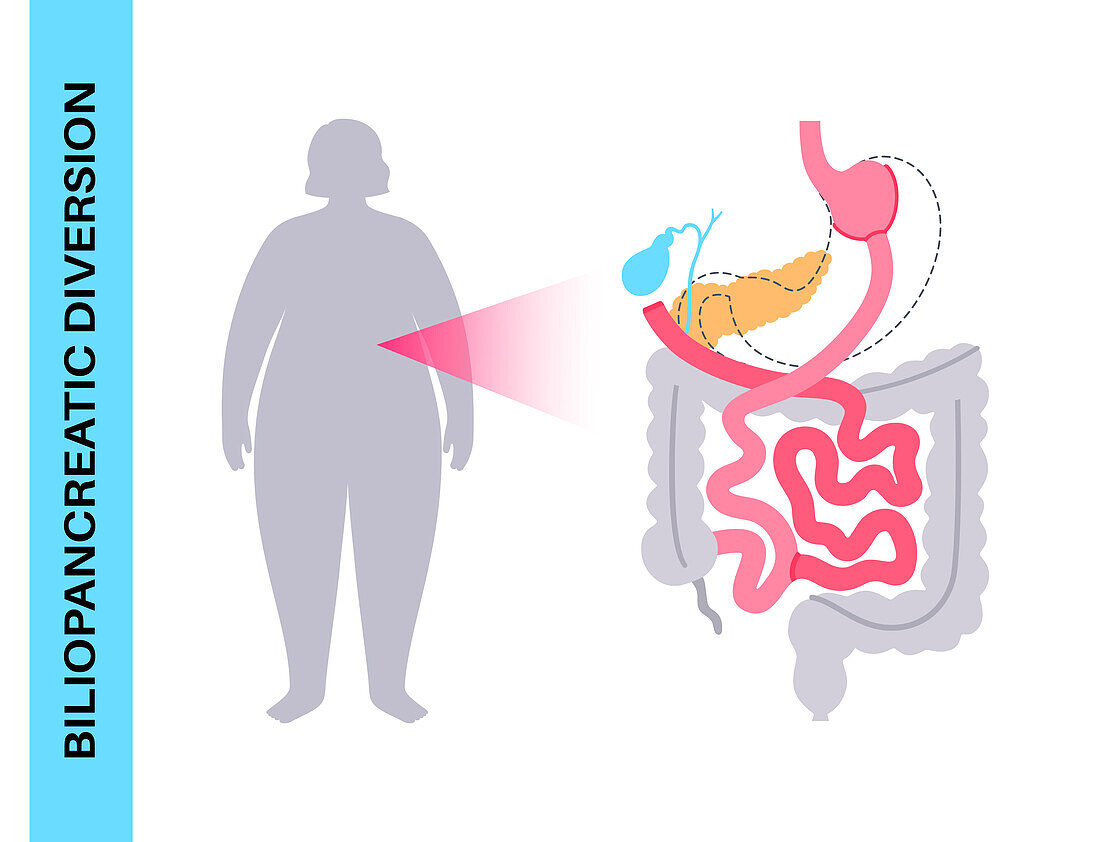 Biliopancreatic diversion procedure, illustration