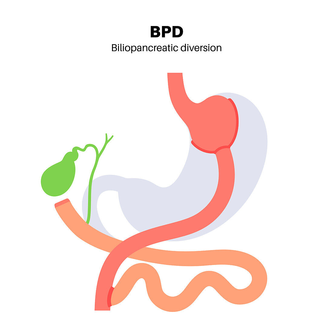 Biliopancreatic diversion procedure, illustration